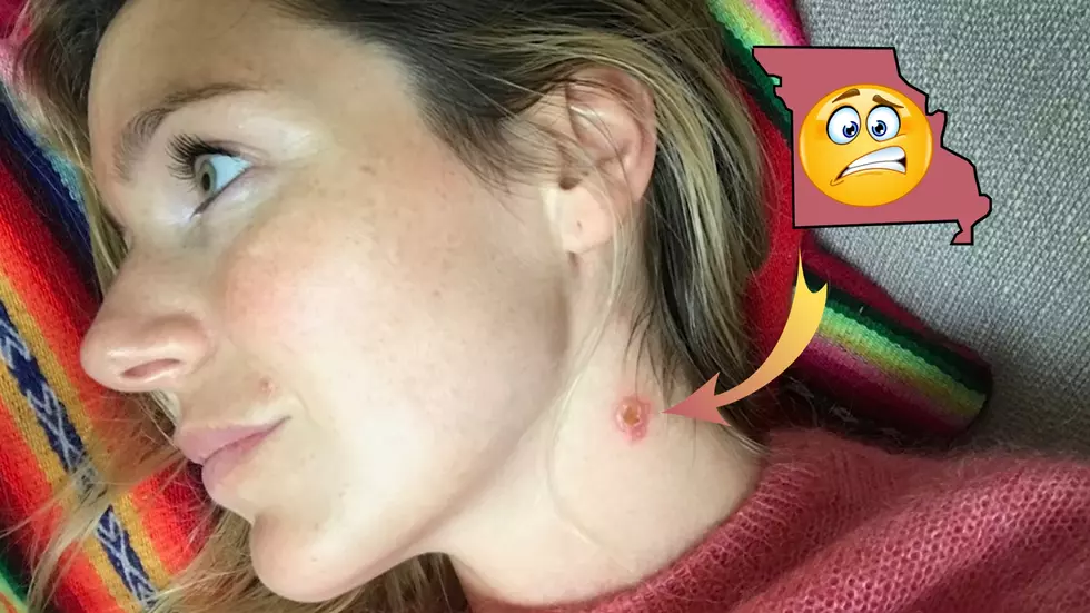 Skin-disfiguring Parasite May Be Just Across Missouri Border?
